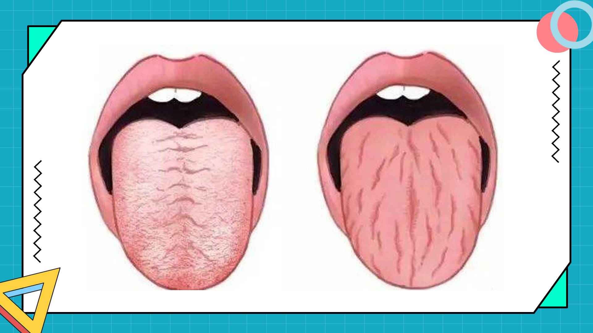 舌苔厚白是什么原因(舌头中间有裂纹是什么原因引起的)